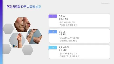 평편사마귀 연고 이미지 2